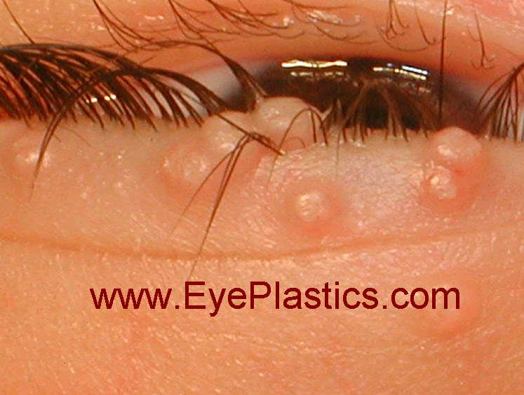 Image of Molluscum Contagiosum